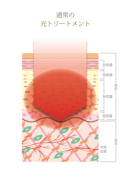 通常の光トリートメント
